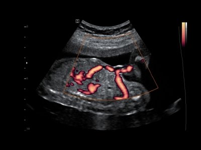 Fetus, blood circulation, PDI / RuScan 50