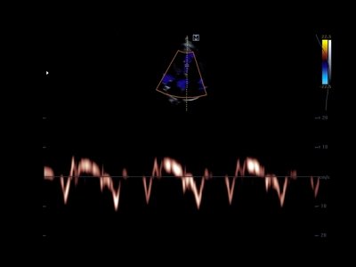 Heart, Spectral TDI mode/ RuScan 50