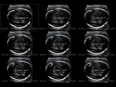 Fetus, brain, MSV / RuScan 50
