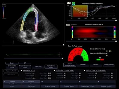 Heart, global and segmental LV strain assessment / RuScan 50