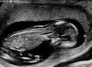 Fetus, 1st trimester / RuScan 65