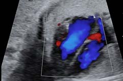 Fetus, heart, CFI / RuScan 65M