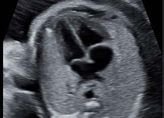 Fetus, heart, four-chamber view / RuScan 65M