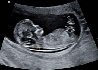 Fetus, NT scan, 2D NT / RuScan 65M