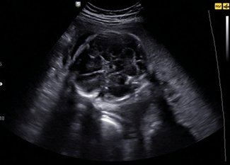 Fetus, brain, Clear Vision / RuScan 70P