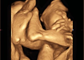 Fetus, lower extremities, 3D / RuScan 70P