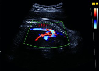 Fetus, aortic arch, S-Flow / RuScan 70P