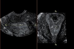 Uterus, Oblique View / RuScan 70P