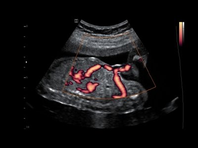 Fetal blood circulation, power doppler / RuScan 50