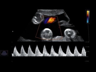 Umbilical vessels, CFM & PW / RuScan 50