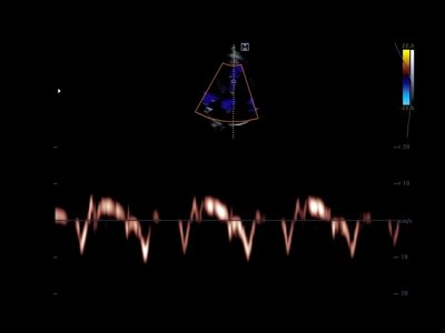 Heart in tissue doppler mode / RuScan 50