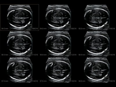 Fetal brain, MSV / RuScan 50