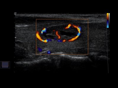 Thyroid nodule in DPDI mode  / RuScan 50