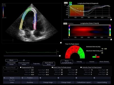 Heart, assessment of global and segmental contractility of the LV / RuScan 50