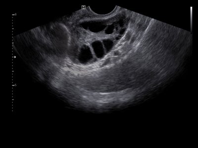 Ovary with follicles / RuScan 50