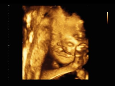 Defect of fetal`s development (cleft palate), 3D / RuScan 50