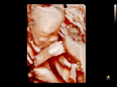 Echogramm was received by ultrasound system RuScan 60