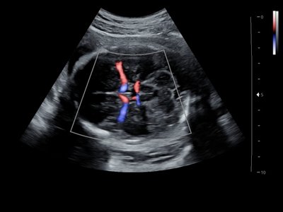 Echogramm was received by ultrasound system RuScan 60