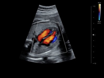 Echogramm was received by ultrasound system RuScan 60