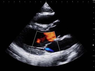 Heart, color doppler / RuScan 65