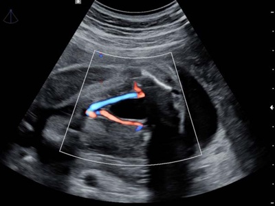Umbilical artery, S-Flow / RuScan 65