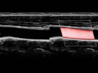 Common carotid artery, S-Flow™ / RuScan 65
