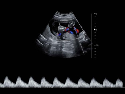 Fetus, umbilical cord, triplex mode / RuScan 65