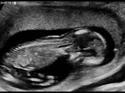 Fetus, 1-st trimester / RuScan 65