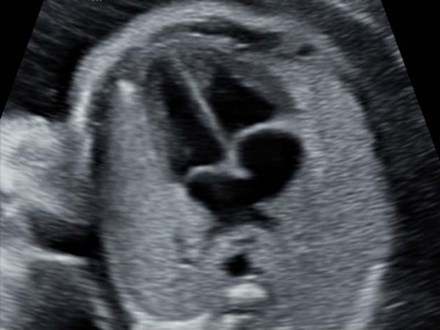 Fetal heart, 4 chamber view / RuScan 65M