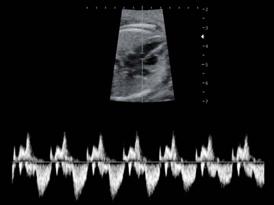 Fetal heart, triplex mode / RuScan 65M