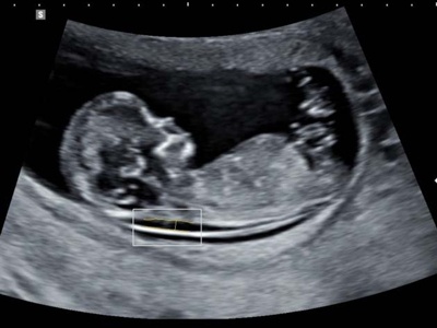 Fetus, nuchal translucency measurement, 2D NT / RuScan 65M