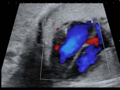 Fetal heart, color doppler / RuScan 65M