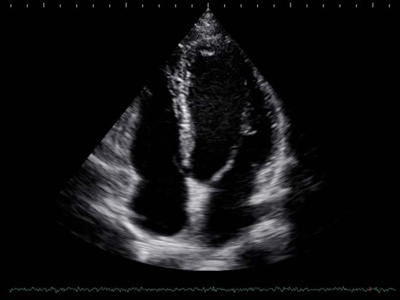 Heart, 4 chamber view / RuScan 65M