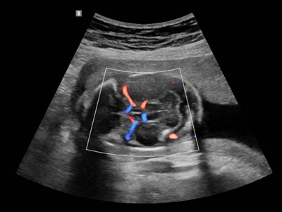 Fetal brain, S-Flow / RuScan 65M