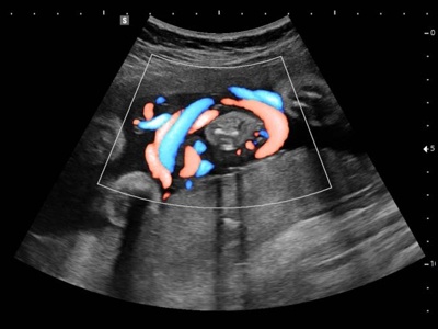 Fetus, umbilical cord, S-Flow / RuScan 65M