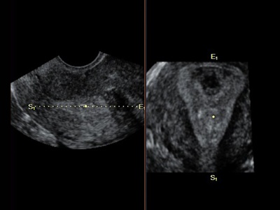 Uterus, Oblique View / RuScan 70P