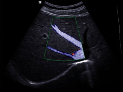 Liver veins, S-Flow / RuScan 70P