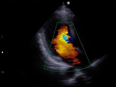 Heart, color doppler / RuScan 70P