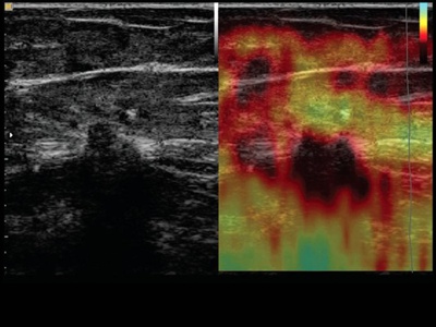 Mamma, elastography / RuScan 70P