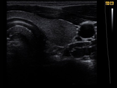 Thyroid right lobe / RuScan 70P