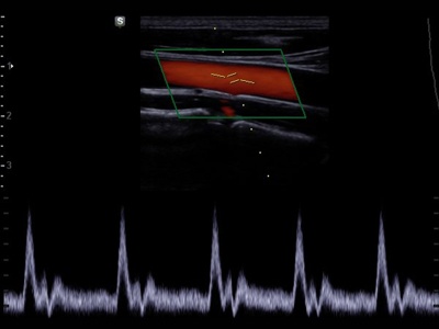 Common carotid artery, triplex mode / RuScan 70P
