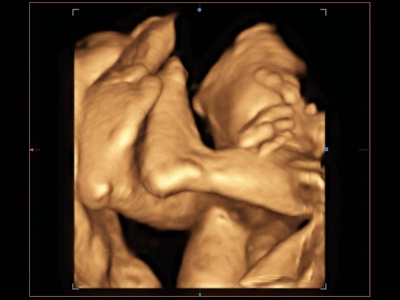 Fetus, lower extremities, 3D / RuScan 70P