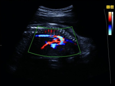 Fetus, aortic arch, S-Flow / RuScan 70P